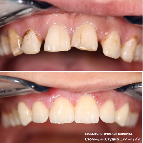 Описание: C:\Users\-\Desktop\клиника\фото работ\виниры2\veneers_stomartstudio.jpg
