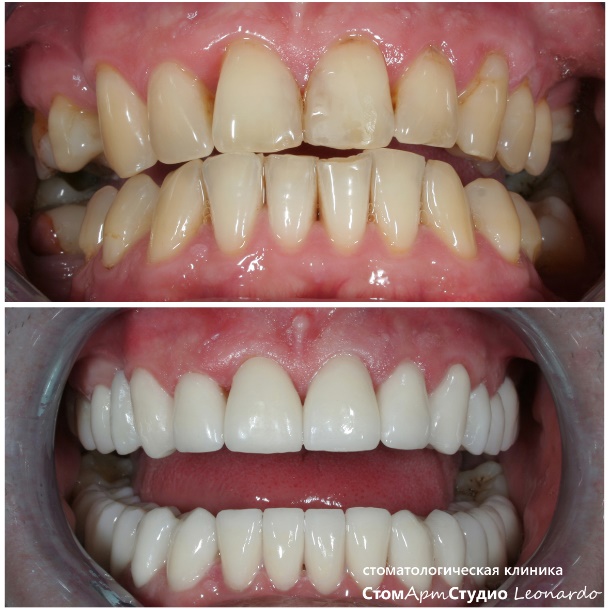 коронки на передние зубы фото