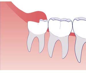 Капюшон над зубом мудрости