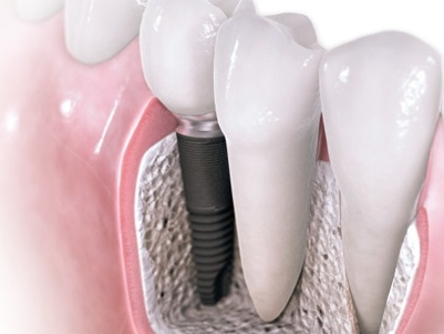 ИМПЛАНТАЦИЯ