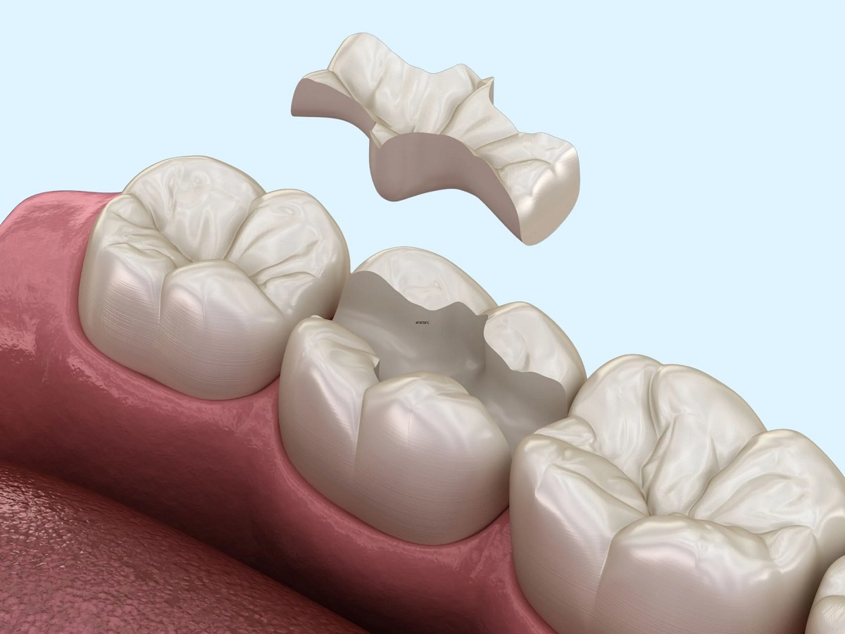 КЕРАМИЧЕСКИЕ ВКЛАДКИ