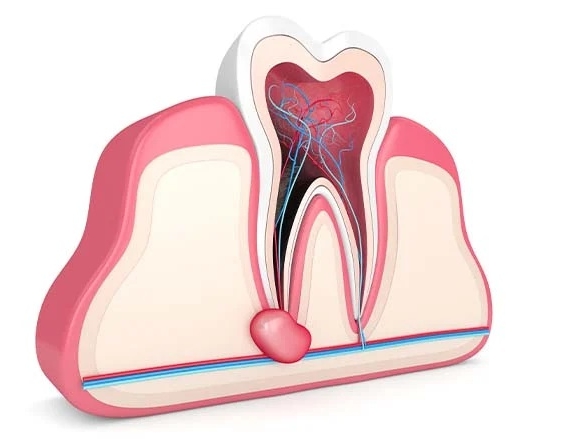 ПЕРИОДОНТИТ (киста)