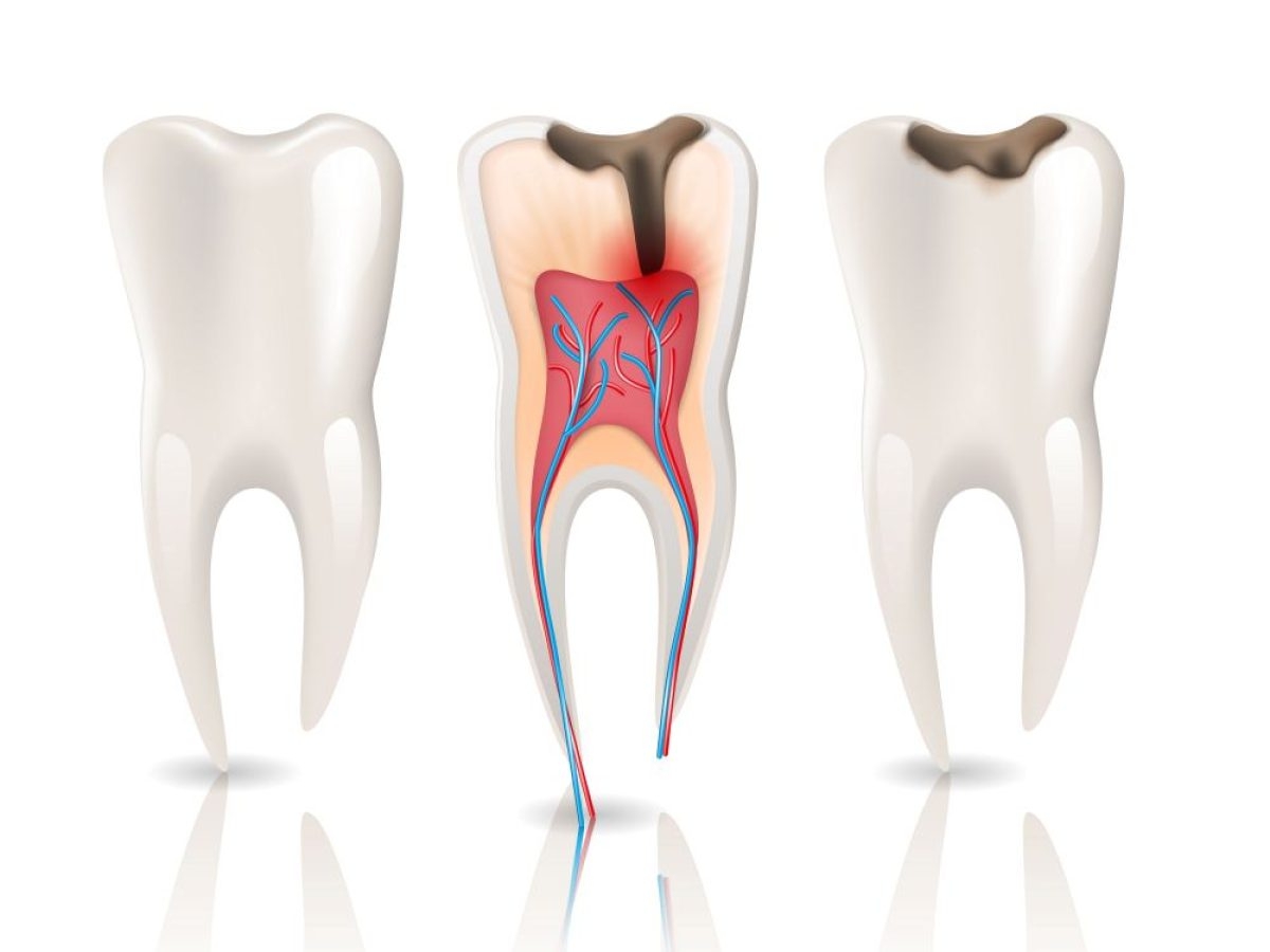 ПУЛЬПИТ (воспаление нерва)