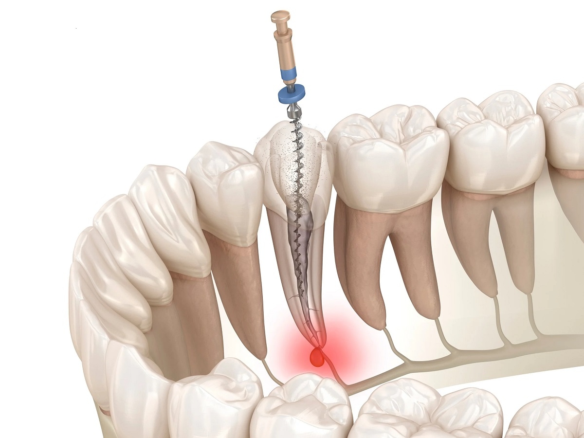 ЛЕЧЕНИЕ КАНАЛОВ