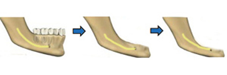 перегрузка передних зубов