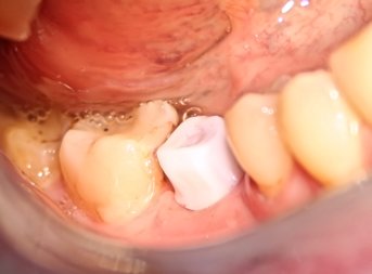 В гипсовой модели челюсти пациента установлен аналог имплантата