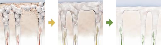 Реминерализация эмали, рекомендации после отбеливая зубов Zoom
