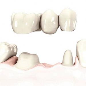 протез на один или два зуба фото 