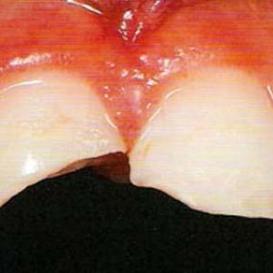 передние зубы до установки керамических виниров фото